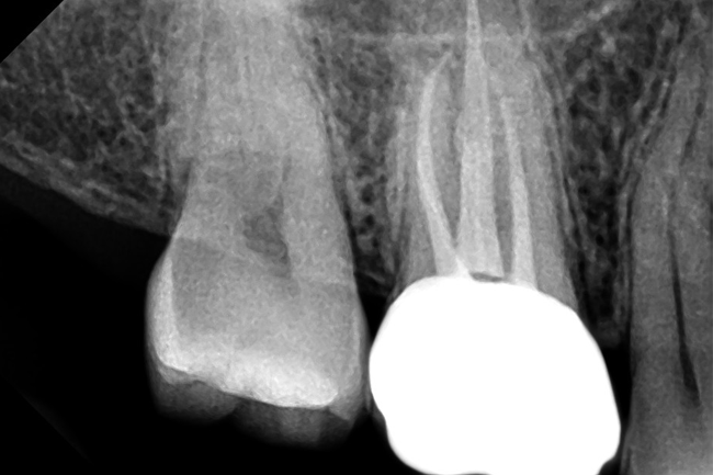 Treatment-Root-Canal-Therapy