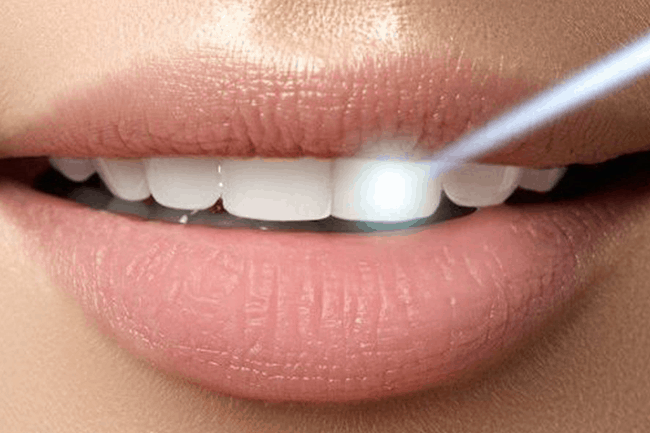 Treatments-Laser-Dentistry